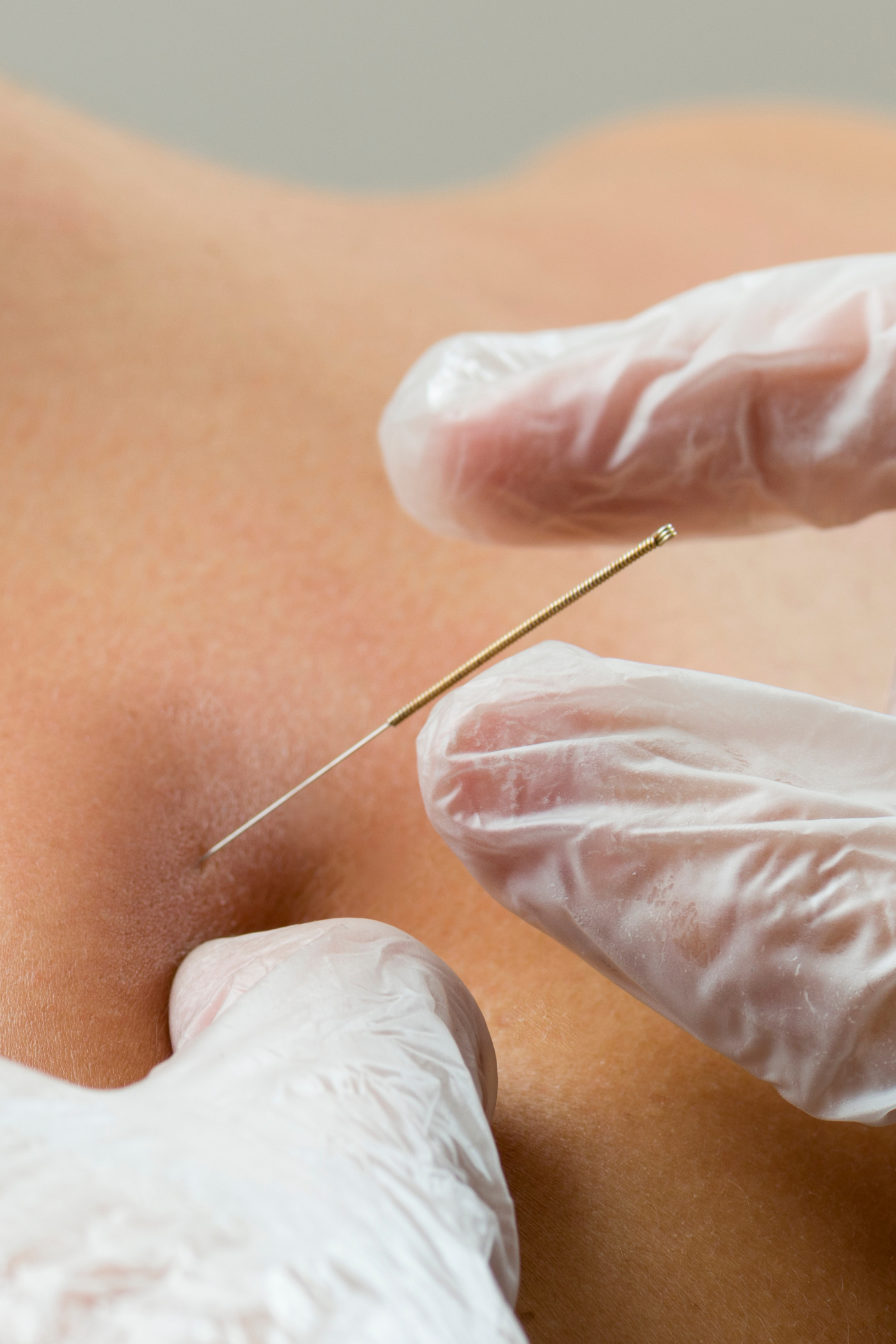 dry needling in melbourne - image